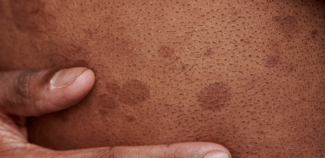 How to reduce the pigmentation on the face?